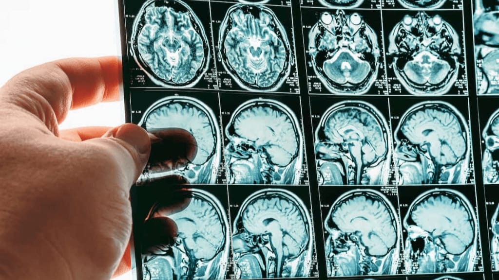 Pria Bugar Alami Stroke Akibat Kecanduan Minuman Berenergi